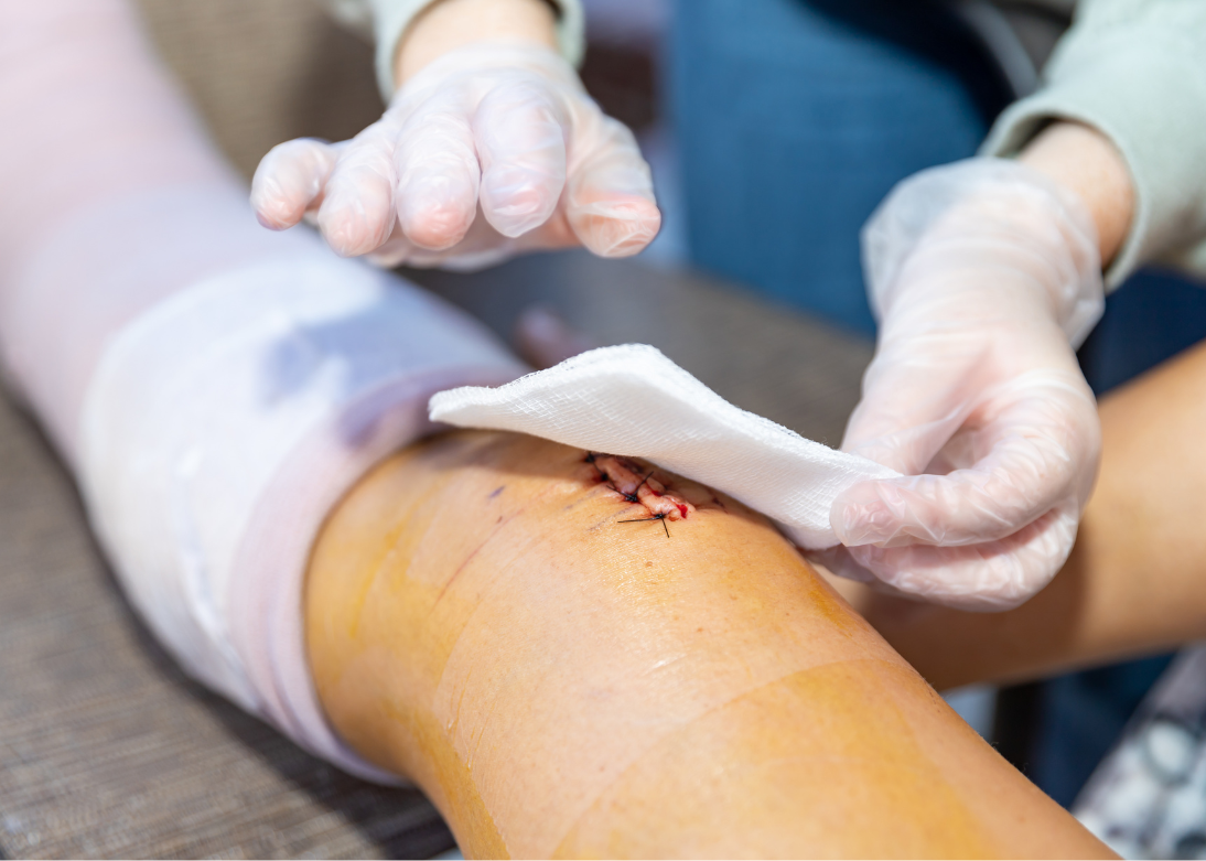 Wound Care & Burns